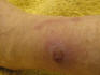 Spider bite, 04/23/10